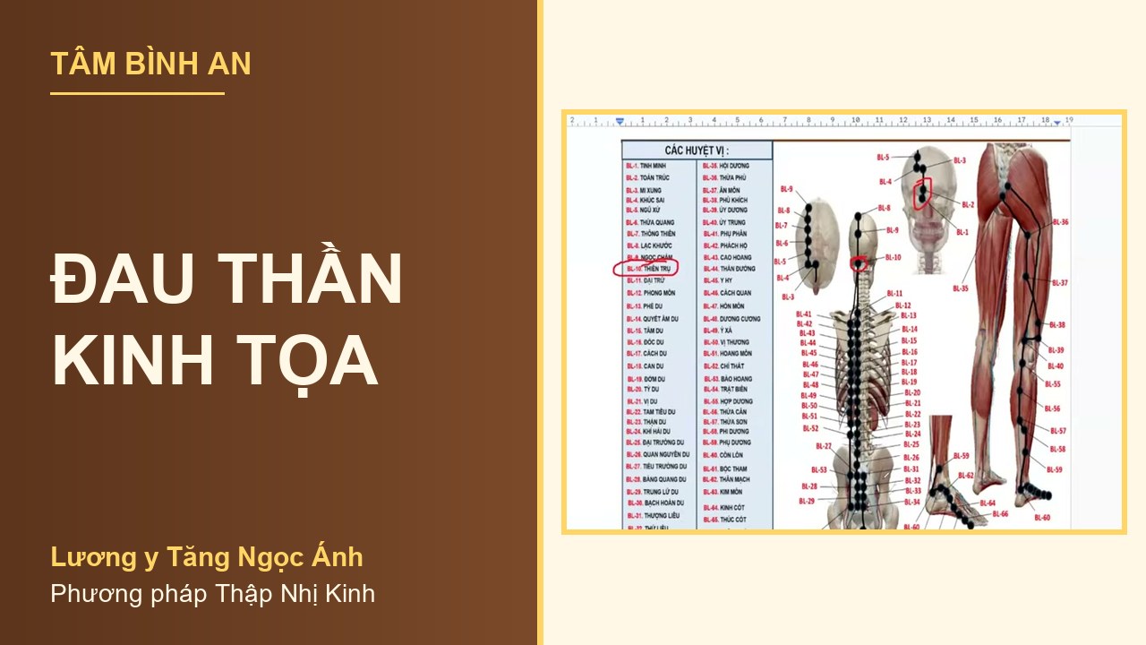 Đau thần kinh tọa - Lương y Tăng Ngọc Ánh Đau thần kinh tọa - Lương y Tăng Ngọc Ánh, phương pháp Thập Nhị Kinh
