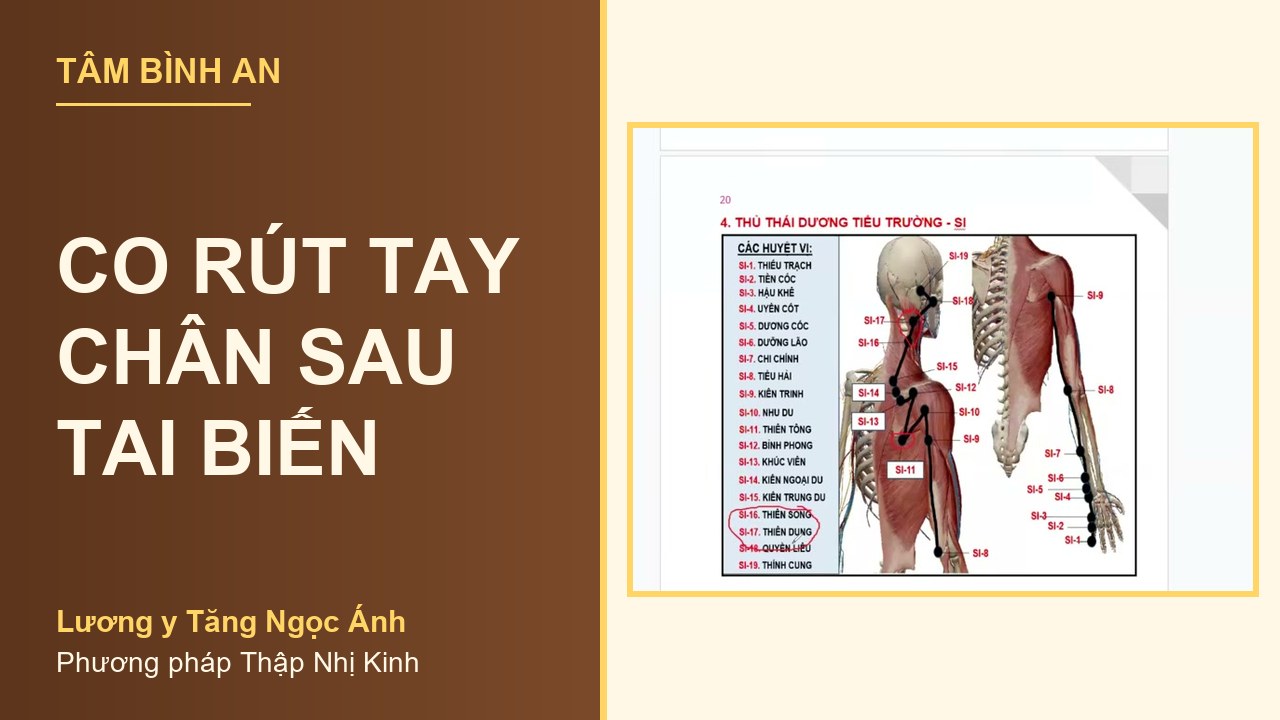 Co rút tay chân sau tai biến - Lương y Tăng Ngọc Ánh Co rút tay chân sau tai biến - Lương y Tăng Ngọc Ánh, phương pháp Thập Nhị Kinh