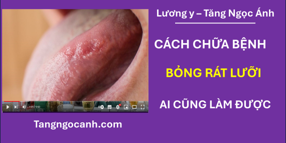 cách chữa bỏng rát lưỡi